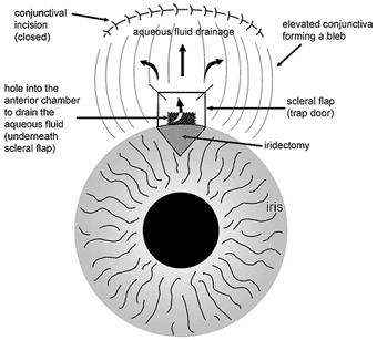 8-6(trabeculectomy) 8-6(trabeculectomy)